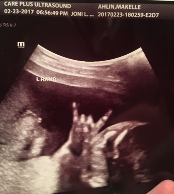ロックポーズをとる胎児の超音波写真が話題に 指をたてて完全に「ロックンロール」!!!