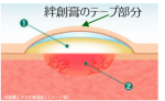 ケアリーヴ治す⼒_モイストヒーリング（湿潤療法）